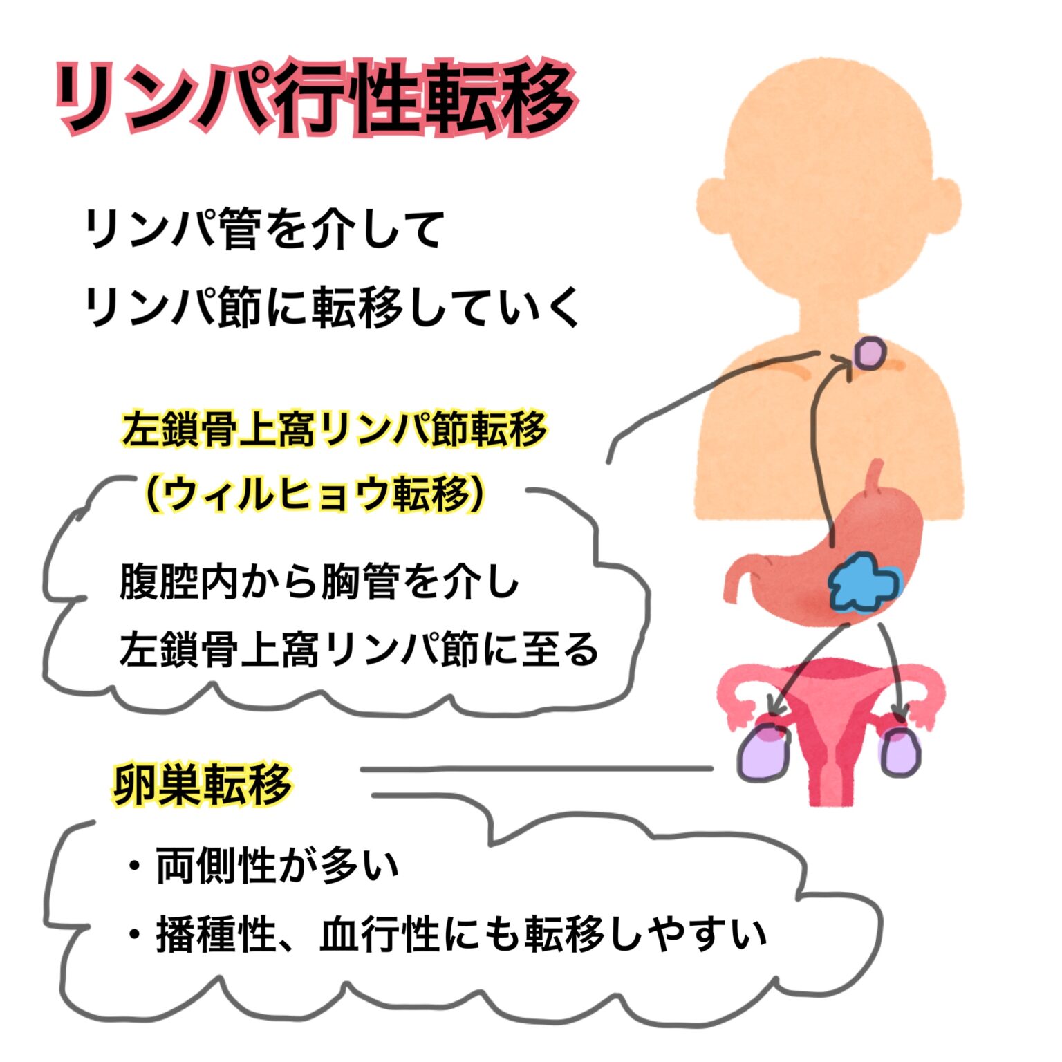 胃癌とは？～絶対忘れない転移の覚え方～ | ハシ@看護師国家試験対策アドバイザー