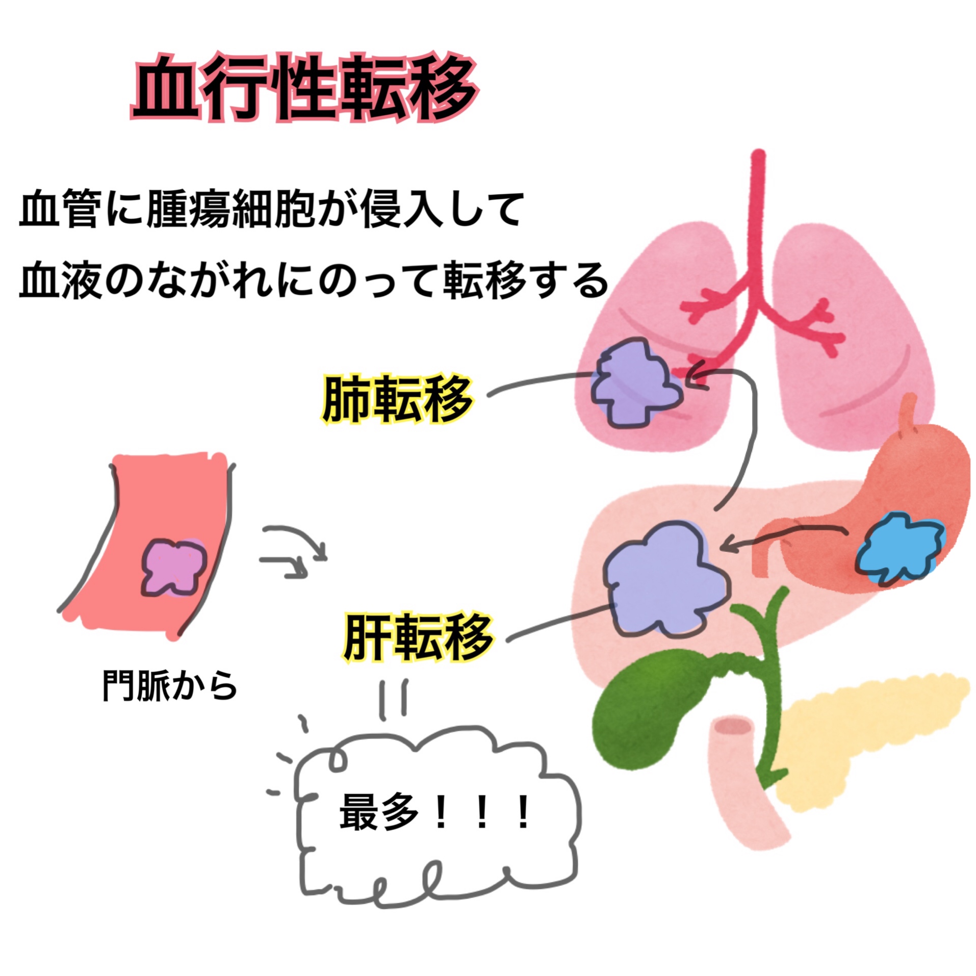 胃癌とは？～絶対忘れない転移の覚え方～ | ハシ@看護師国家試験対策アドバイザー